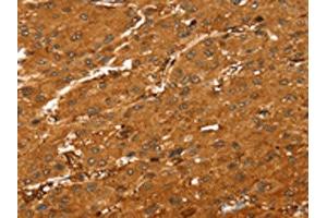 The image on the left is immunohistochemistry of paraffin-embedded Human liver cancer tissue using ABIN7189594(ABCC9 Antibody) at dilution 1/35, on the right is treated with synthetic peptide. (ABCC9 antibody)