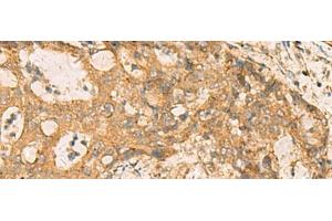 Immunohistochemistry of paraffin-embedded Human cervical cancer tissue using CNST Polyclonal Antibody at dilution of 1:70(x200) (CNST antibody)