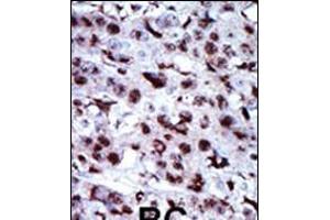 Formalin-fixed and paraffin-embedded human cancer tissue reacted with the primary antibody, which was peroxidase-conjugated to the secondary antibody, followed by AEC staining. (Adenylate Kinase 5 antibody  (N-Term))