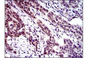 Immunohistochemical analysis of paraffin-embedded esophageal cancer tissues using CLGN mouse mAb with DAB staining. (Calmegin antibody  (AA 249-405))