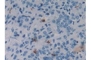 Detection of REG3g in Human Prostate cancer Tissue using Polyclonal Antibody to Regenerating Islet Derived Protein 3 Gamma (REG3g)