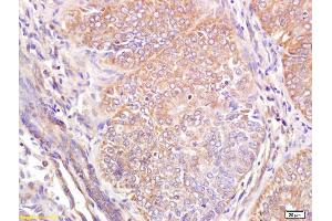 Formalin-fixed and paraffin embedded human breast carcinoma labeled with Anti Wnt6 Polyclonal Antibody, Unconjugated (ABIN762926) at 1:200 followed by conjugation to the secondary antibody and DAB staining