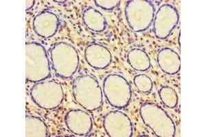 Immunohistochemistry of paraffin-embedded human gastric cancer using ABIN7147541 at dilution of 1:100