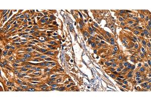 Immunohistochemistry of paraffin-embedded Human esophagus cancer tissue using Galectin 8 Polyclonal Antibody at dilution 1:50 (LGALS8 antibody)