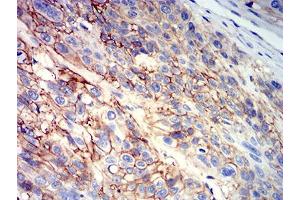 Immunohistochemical analysis of paraffin-embedded esophageal cancer tissues using CD147 mouse mAb with DAB staining. (CD147 antibody  (AA 138-323))