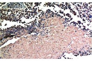 Immunohistochemistry of paraffin-embedded Human lung carcinoma tissue using AKT1 Monoclonal Antibody at dilution of 1:200. (AKT1 antibody)