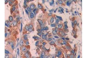 DAB staining on IHC-P; Samples: Human Breast cancer Tissue (ECT2 antibody  (AA 166-348))