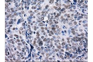 Immunohistochemical staining of paraffin-embedded Adenocarcinoma of colon tissue using anti-L1CAMmouse monoclonal antibody. (L1CAM antibody)