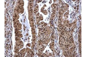 IHC-P Image SP1 antibody detects SP1 protein at nucleus on human gastric carcinoma by immunohistochemical analysis. (SP1 antibody  (C-Term))