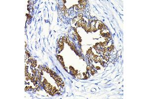 Immunohistochemistry of paraffin-embedded human prostate cancer using KLK3 Rabbit pAb (ABIN3022794, ABIN3022795, ABIN3022796 and ABIN6219231) at dilution of 1:100 (40x lens). (Prostate Specific Antigen antibody  (AA 1-100))