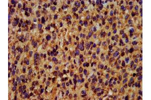 IHC image of ABIN7173439 diluted at 1:400 and staining in paraffin-embedded human glioma performed on a Leica BondTM system. (TRIM35 antibody  (AA 1-206))
