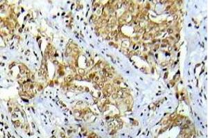 Immunohistochemistry analysis Phospho-Abl1 antibody in paraffin-embedded human breast carcinoma tissue. (ABL1 antibody  (pTyr412))