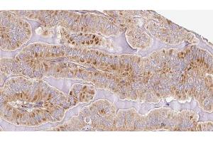ABIN6267093 at 1/100 staining Human thyroid cancer tissue by IHC-P. (ATG13 antibody  (pSer355))