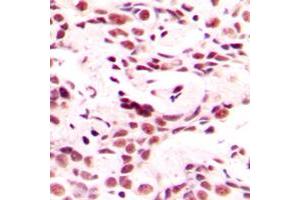 Immunohistochemical analysis of HOXB9 staining in human breast cancer formalin fixed paraffin embedded tissue section. (HOXB9 antibody  (C-Term))
