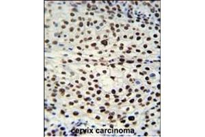 HNRB Antibody (N-term) (ABIN651713 and ABIN2840371) immunohistochemistry analysis in formalin fixed and raffin embedded human cervix carcinoma followed by peroxidase conjugation of the secondary antibody and DAB staining. (HNRNPAB antibody  (N-Term))