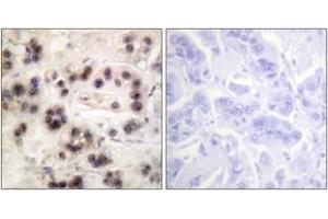 Immunohistochemistry analysis of paraffin-embedded human breast carcinoma, using p63 (Phospho-Ser455) Antibody. (TCP1 alpha/CCTA antibody  (pSer455))