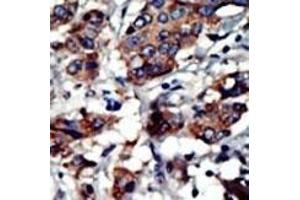 Formalin-fixed and paraffin-embedded human cancer tissue reacted with the primary antibody, which was peroxidase-conjugated to the secondary antibody, followed by AEC staining. (PACSIN3 antibody  (N-Term))