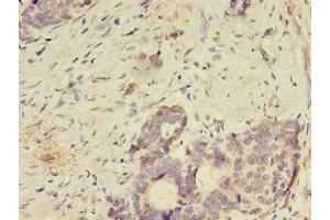 Immunohistochemistry of paraffin-embedded human gastric cancer using ABIN7166144 at dilution of 1:100 (SPIRE2 antibody  (AA 79-388))