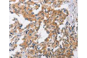 Immunohistochemistry of Human gastric cancer using CHMP1A Polyclonal Antibody at dilution of 1:60 (CHMP1A antibody)