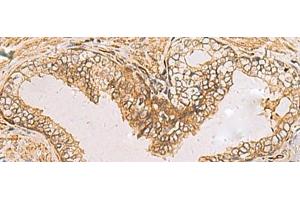 Immunohistochemistry of paraffin-embedded Human prost ate cancer tissue using RAB38 Polyclonal Antibody at dilution of 1:60(x200) (RAB38 antibody)
