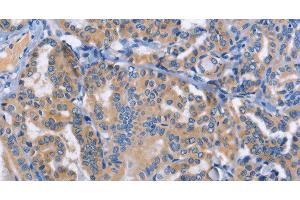 Immunohistochemistry of paraffin-embedded Human thyroid cancer tissue using DOK4 Polyclonal Antibody at dilution 1:50 (DOK4 antibody)