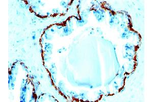 Formalin-fixed, paraffin-embedded human Prostate Carcinoma stained with Cytokeratin, HMW Monoclonal Antibody (SPM591).