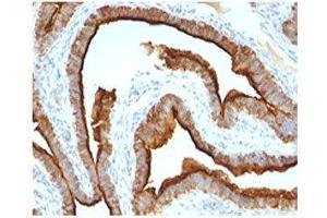Epithelial Marker Antigen antibody IHC testing of formalin-paraffin human ovarian cancer tissue. (Epithelial Marker Antigen antibody)