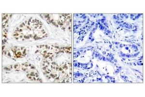Immunohistochemical analysis of paraffin-embedded human breast carcinoma tissue using RelB(Phospho-Ser573) Antibody(left) or the same antibody preincubated with blocking peptide(right). (RELB antibody  (pSer573))