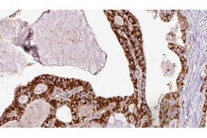 ABIN6267205 at 1/100 staining Human thyroid cancer tissue by IHC-P. (ULK1 antibody  (pSer467))