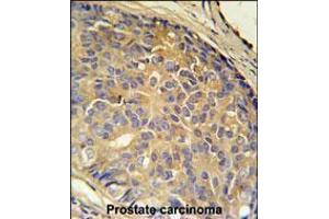 LOH12CR1 Antibody immunohistochemistry analysis in formalin fixed and paraffin embedded human prostate carcinoma followed by peroxidase conjugation of the secondary antibody and DAB staining. (LOH12CR1 antibody  (C-Term))