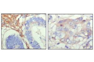 Immunohistochemical analysis of paraffin-embedded human colon cancer (left) and breast cancer (right) showing cytoplasmic localization with DAB staining using FBLN5 mouse mAb. (Fibulin 5 antibody  (AA 242-448))