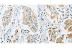 Immunohistochemistry of paraffin-embedded Human breast cancer tissue using ARHGEF10 Polyclonal Antibody at dilution 1:45 (ARHGEF10 antibody)