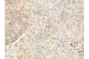 ABIN6259146 and ABIN6273735 at 1/100 staining human esophageal carcinoma by IHC-P.