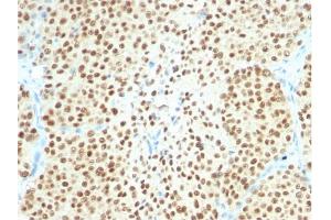 Formalin-fixed, paraffin-embedded human Melanoma stained with SOX10-Monospecific Recombinant Rabbit Monoclonal Antibody (SOX10/2311R). (Recombinant SOX10 antibody  (AA 115-269))