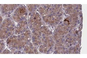ABIN6273983 at 1/100 staining Human liver cancer tissue by IHC-P.