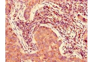 Immunohistochemistry of paraffin-embedded human pancreatic cancer using ABIN7153219 at dilution of 1:100 (FAM160A2 antibody  (AA 1-300))