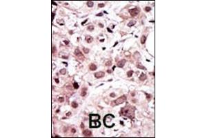 Formalin-fixed and paraffin-embedded human cancer tissue reacted with the primary antibody, which was peroxidase-conjugated to the secondary antibody, followed by AEC staining. (AXL antibody  (N-Term))