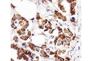 IHC analysis of FFPE human breast carcinoma section using INSRR antibody; Ab was diluted at 1:25. (INSRR antibody  (AA 668-702))