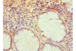 Immunohistochemistry of paraffin-embedded human colon cancer using ABIN7143276 at dilution of 1:100 (TRAF3IP2 antibody  (AA 1-300))