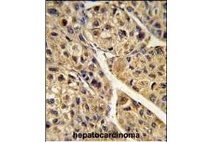 Formalin-fixed and paraffin-embedded human hepatocarcinoma reacted with PEX11A Antibody (N-term), which was peroxidase-conjugated to the secondary antibody, followed by DAB staining. (PEX11A antibody  (N-Term))