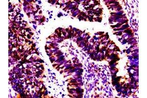 IHC image of ABIN7155808 diluted at 1:100 and staining in paraffin-embedded human ovarian cancer performed on a Leica BondTM system. (Msx2/Hox8 antibody  (AA 50-120))