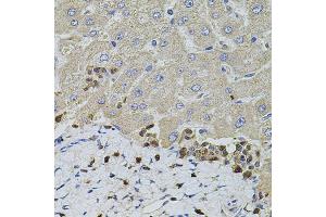 Immunohistochemistry of paraffin-embedded human liver injury using S100A12 antibody (ABIN5973068) at dilution of 1/100 (40x lens). (S100A12 antibody)