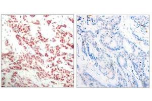 Immunohistochemical analysis of paraffin- embedded human breast carcinoma tissue using NF-κ,B p100 (phospho- ser866) antibody. (NFKB2 antibody  (pSer866))
