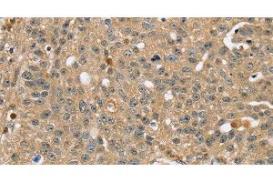 Immunohistochemistry of paraffin-embedded Human breast cancer using RNH1 Polyclonal Antibody at dilution of 1:40 (RNH1 antibody)
