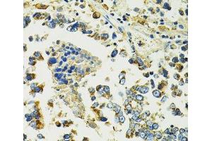 Immunohistochemistry of paraffin-embedded Human colon carcinoma using SLC25A11 Polyclonal Antibody at dilution of 1:100 (40x lens).