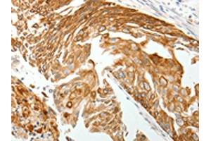 The image on the left is immunohistochemistry of paraffin-embedded Human cervical cancer tissue using ABIN7192814(TMSB10 Antibody) at dilution 1/15, on the right is treated with synthetic peptide. (Thymosin beta 10 antibody)