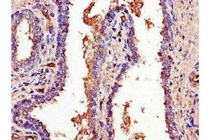 Immunohistochemistry of paraffin-embedded human prostate cancer using ABIN7164882 at dilution of 1:100 (PCOTH antibody  (AA 50-100))