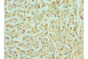 Immunohistochemistry of paraffin-embedded human liver cancer using ABIN7145312 at dilution of 1:100 (BMF antibody  (AA 1-184))