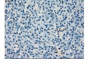 Immunohistochemical staining of paraffin-embedded Adenocarcinoma of breast tissue using anti-IRF3 mouse monoclonal antibody. (IRF3 antibody)