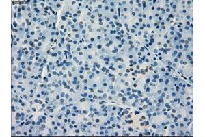 Immunohistochemical staining of paraffin-embedded Adenocarcinoma of breast tissue using anti-IRF3 mouse monoclonal antibody. (IRF3 antibody)